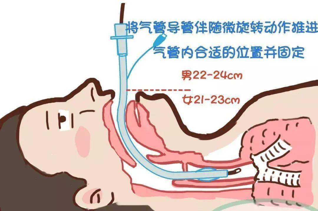 史的病人,我们会直接采用镇静或清醒情况下纤支镜辅助进行气管插管