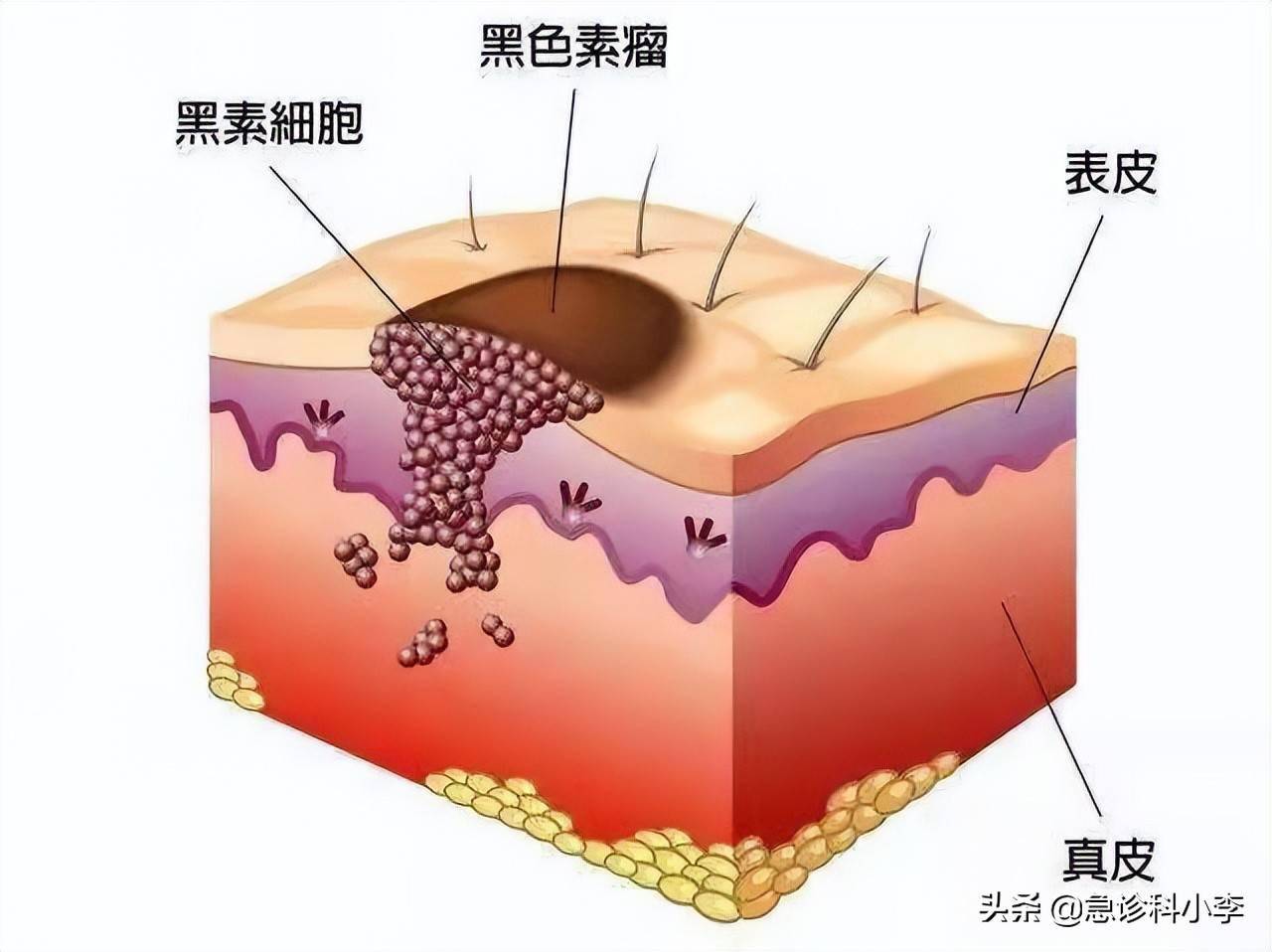 這裡提到的原有痣腫大疼痛是皮膚癌中的惡性黑色素瘤的典型表現,四個