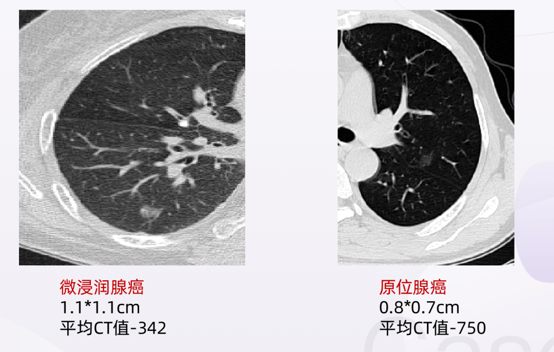 随访or切除肺结节ct评估注意这2点