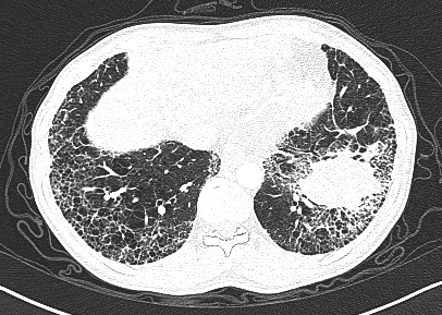 这份肺纤维化肺癌67读片秘籍请收好