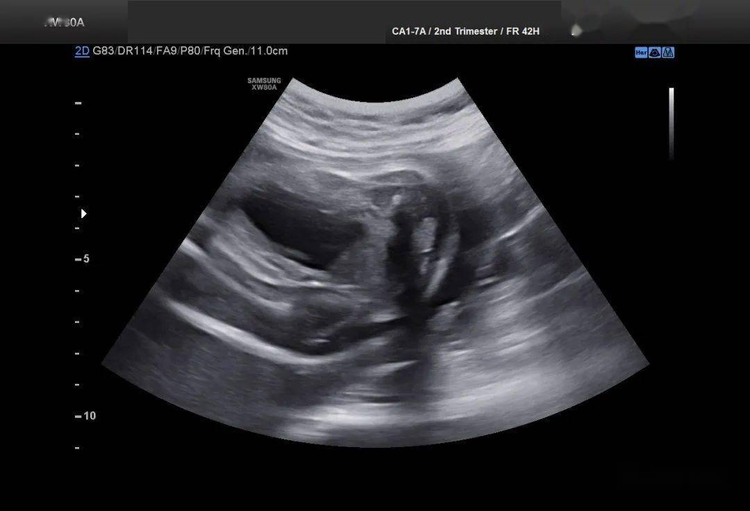 6个月男胎儿的睾丸图图片