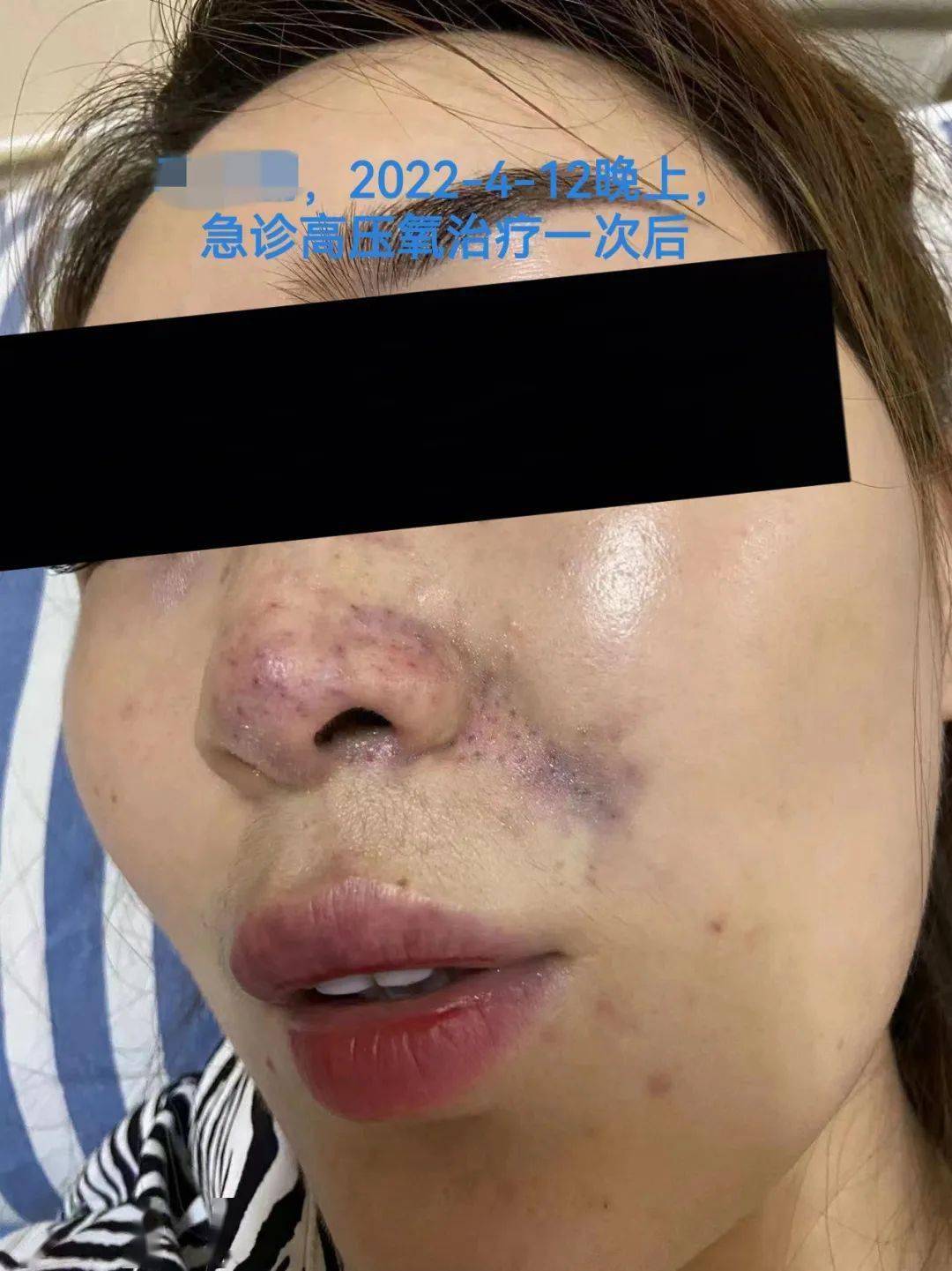 聚焦临床医美后受的这种伤高压氧能治疗有图有真相