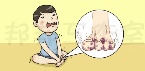 足癣的预防和治疗