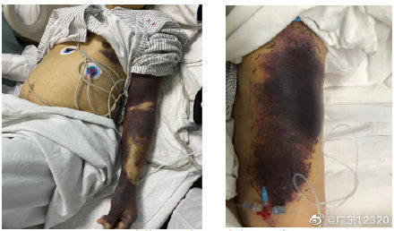 76岁阿伯自行刮痧后送进icu,一查竟患有血友病_陈伯_疾病_症状