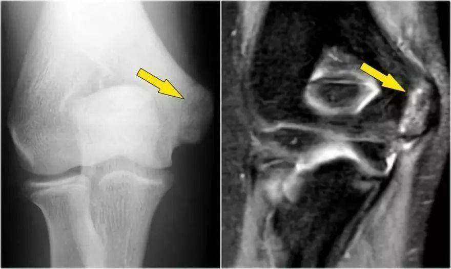 肘關節常見病的mri圖譜詳解