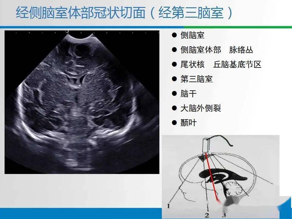 文献复习与病例讨论61新生儿颅脑超声解剖