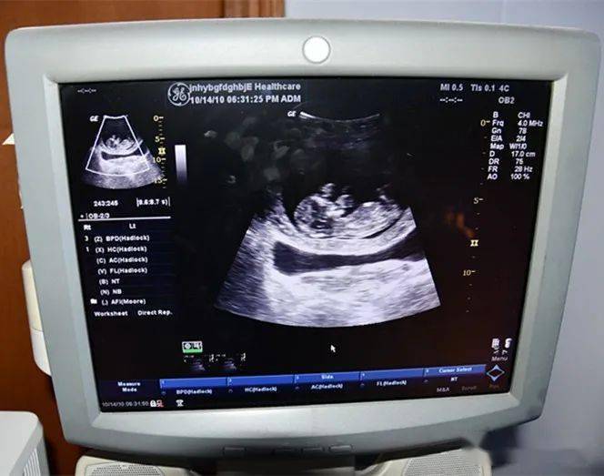 作为早期筛查胎儿畸形必不可少的一项检查