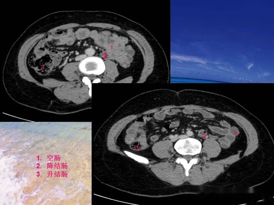 消化道穿孔ct影像大汇总看完印象深刻