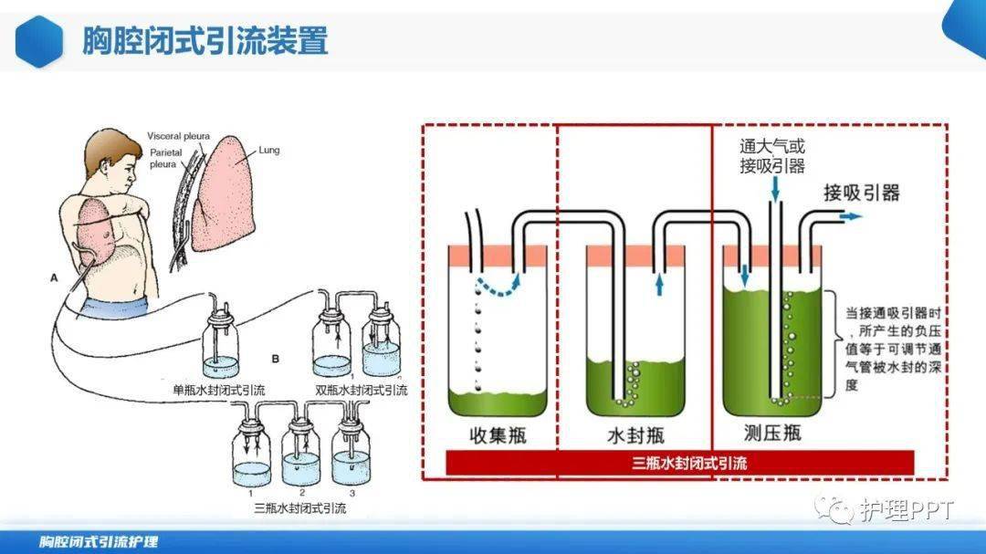 ppt胸腔闭式引流管的护理
