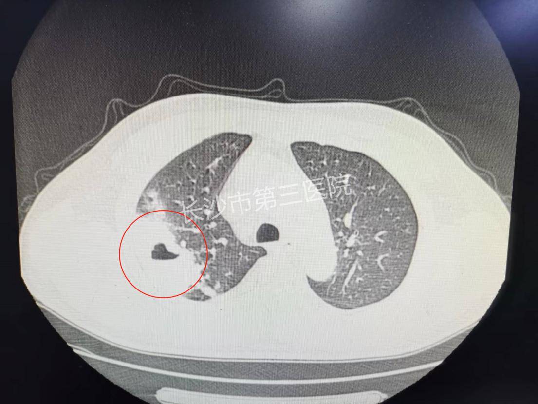 没把咳嗽当回事长沙52岁大叔肺上咳出拳头大窟窿