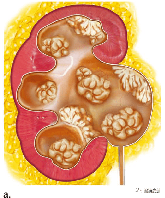 (b-e) 33岁女性,肉眼血尿和左腹肿块,大的肾积水囊内出现巨大的乳头状