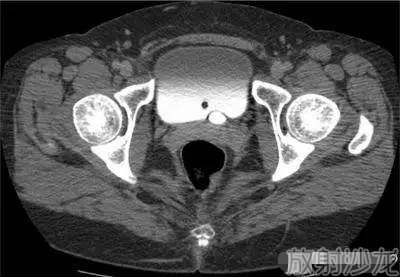 膀胱ct解剖图片