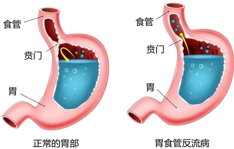 胃,十二指腸內容物反流到食管,從而引起反酸,燒心等症狀的疾病