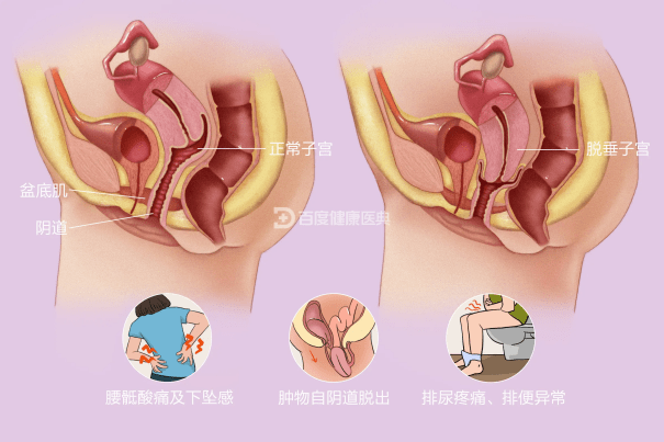 产后漏尿,阴道松弛……告别尴尬,这件事一定要做好!