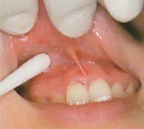 口腔局部浸润麻醉方法