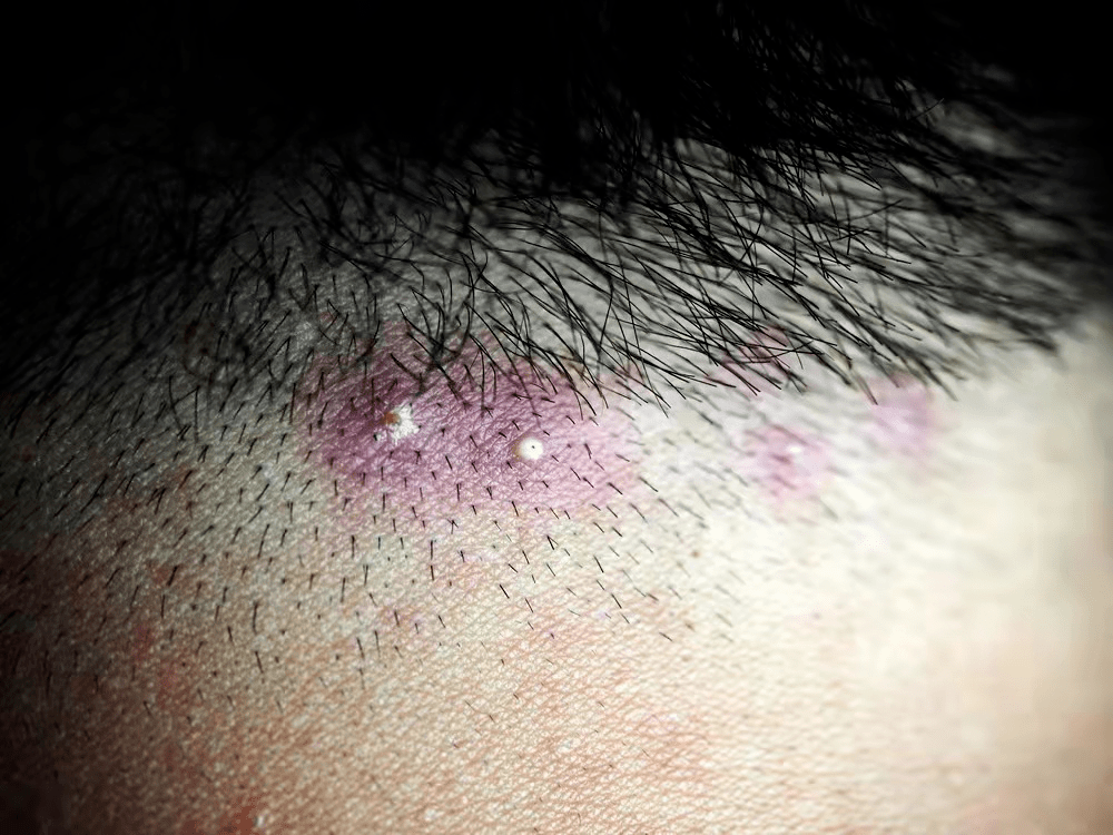 马拉_皮肤_毛囊