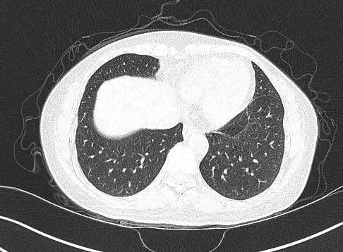 再把这个写成肺纤维条索影主任就要发火了