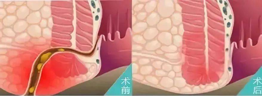 治肛瘘，中医有哪些高招？