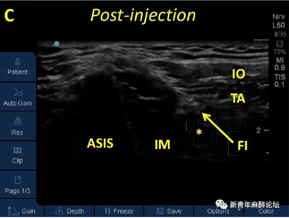 神经阻滞丨超声引导下腰丛及其分支神经阻滞