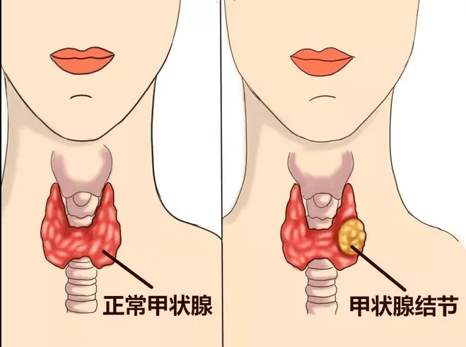 女性甲状腺位置图图片