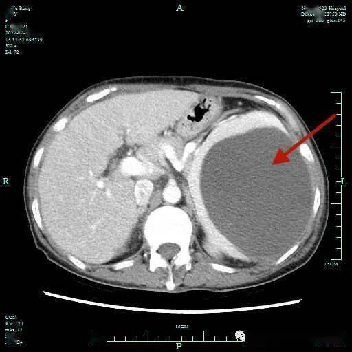 术前患者ct照片(箭头方向为患者脾血肿位置"多亏部队医院医护人员