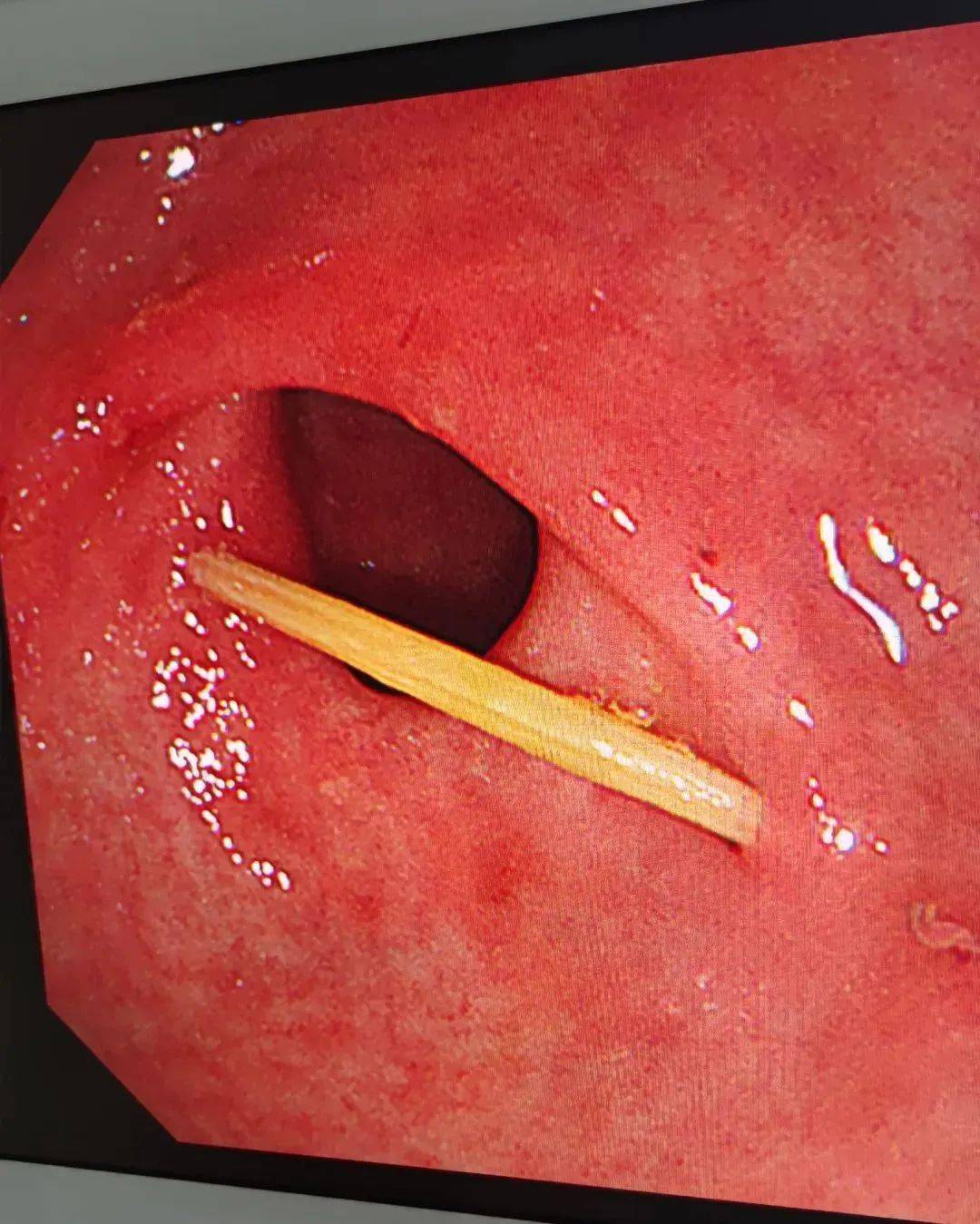 男子误吞牙签,医生"巧"取异物化险为夷_内镜_消化道_治疗