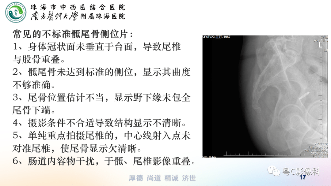 骶尾骨x线解剖图片