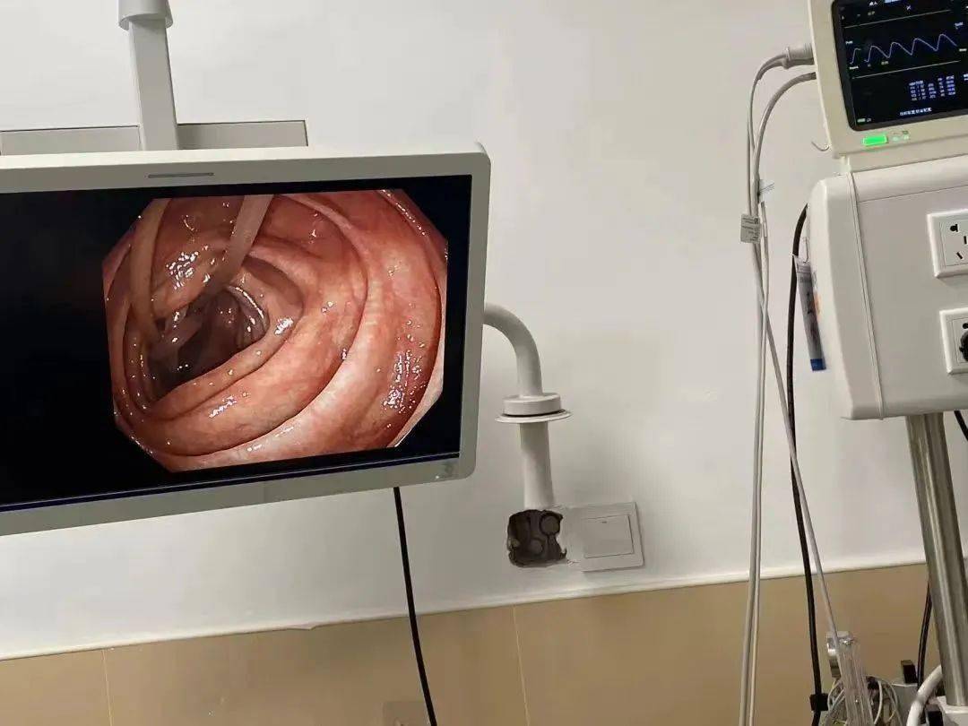 女子肠子里有一团蛔虫,个头比筷子还粗!