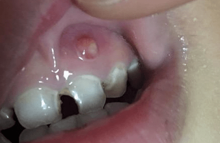 牙瘘管出现小脓包图片图片