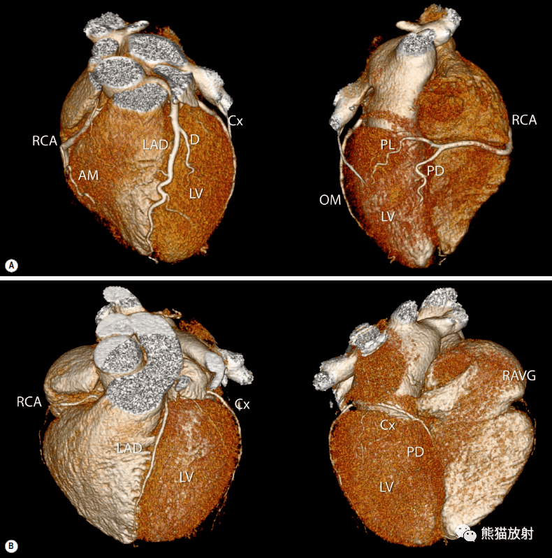 冠状动脉ct:相关概念,解剖_回旋_显示_分支