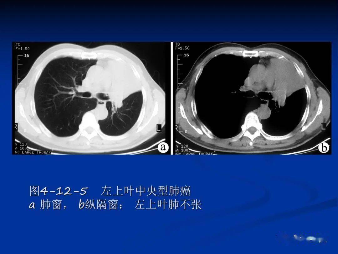 肺肿瘤影像大汇总，看完深刻理解
