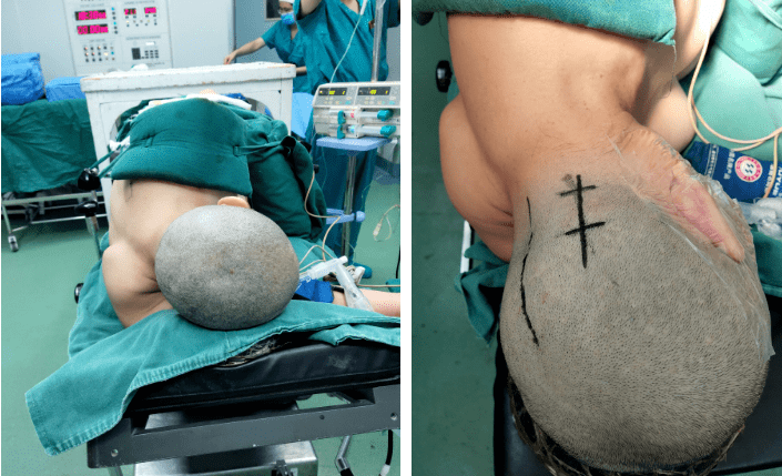 病例分享霍峻峰主任基于burrhole技术下的krause入路切除小脑血管母