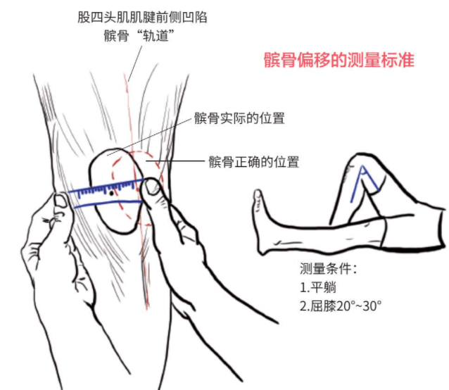 在具體膝關節屈伸的角度下,測量髕骨的位置(圖3)