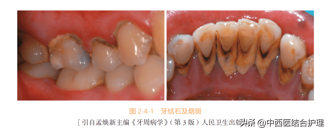 牙结石和牙垢的区别图片