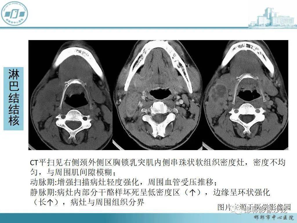 颈侧瘘管图片