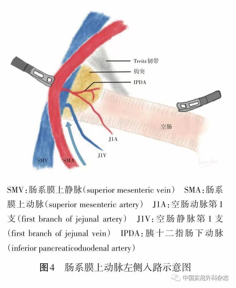 专题笔谈|腹腔镜胰十二指肠切除术手术入路选择及评价(本文配发视频)_门静脉_动脉_肿瘤