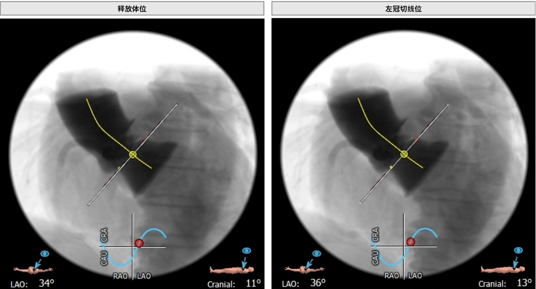 西南医科大学附属医院范忠才主任团队独立完成一台高难度tavr手术