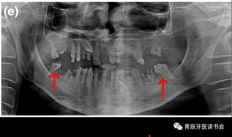 牛牙症的根管治疗