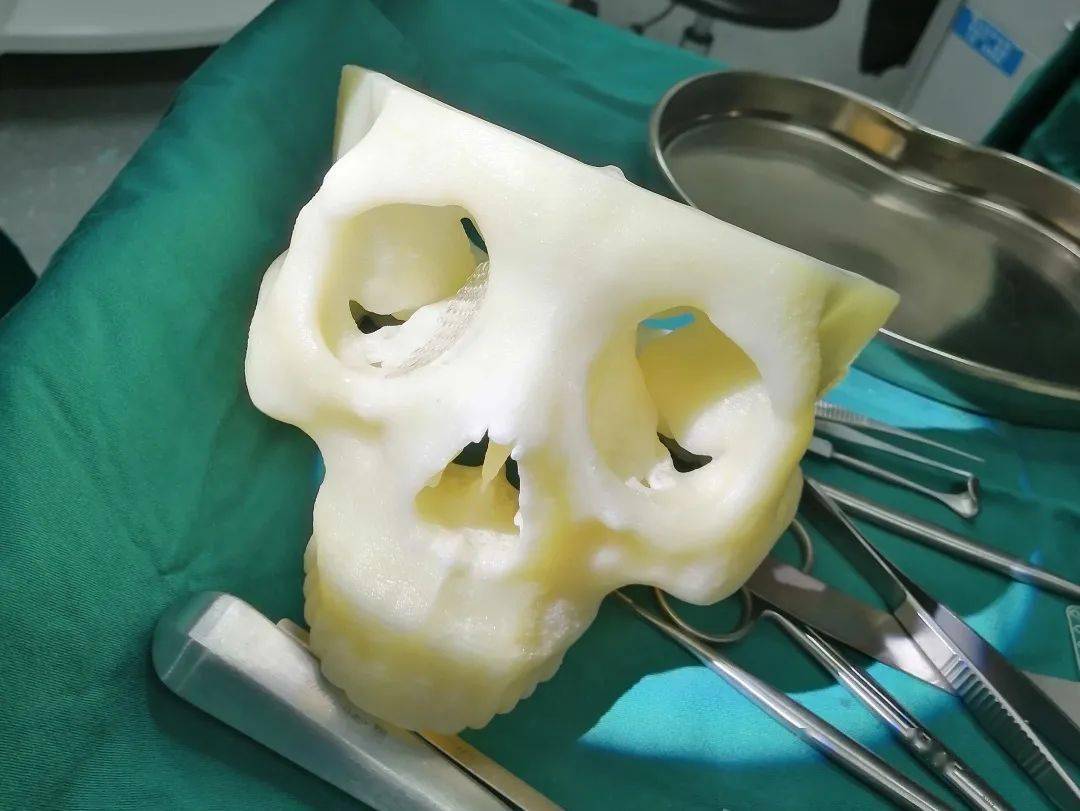 【技术突破】市第一人民医院成功实施首例3d打印眼眶骨修复术_手术