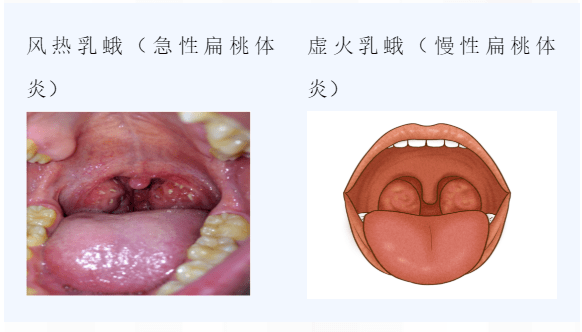 双咽喉是什么样子的图片