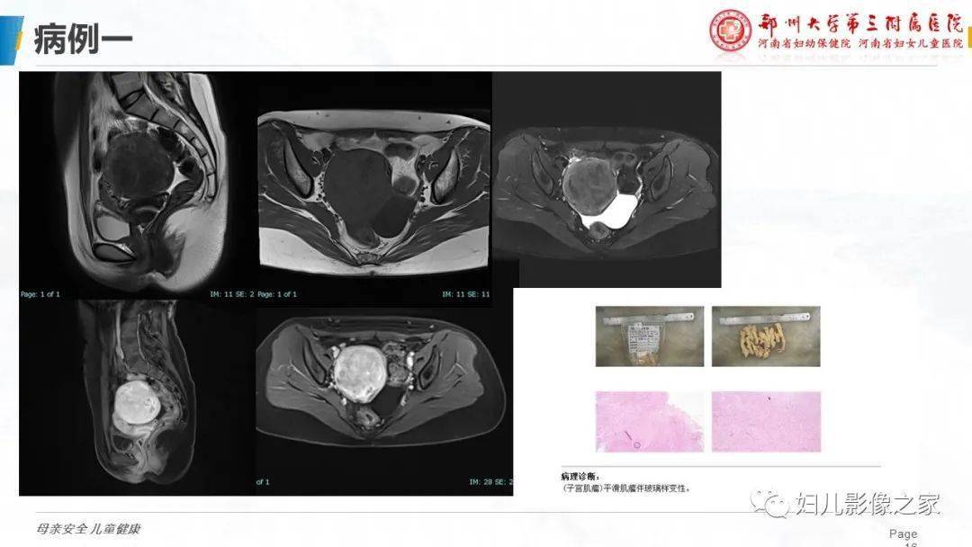 子宫平滑肌瘤变性的影像诊断