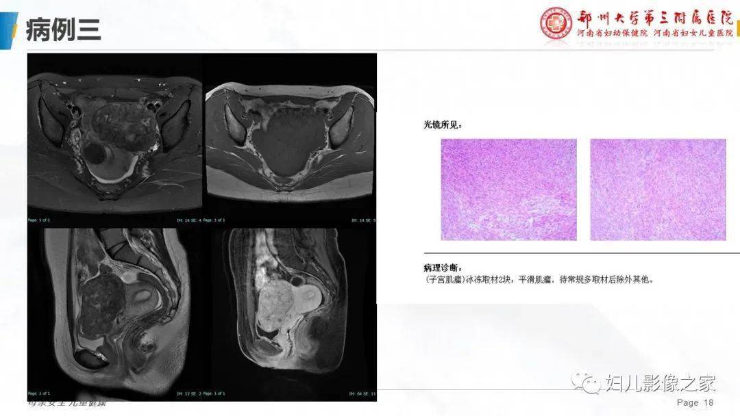 子宫平滑肌瘤变性的影像诊断