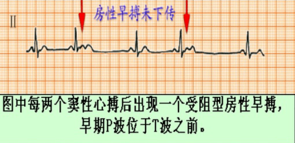 心电图总是记不住这个速记口诀收藏起来