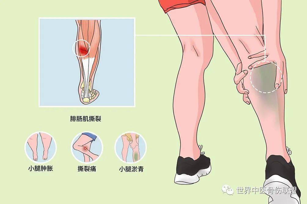 腓肠肌位置图图片