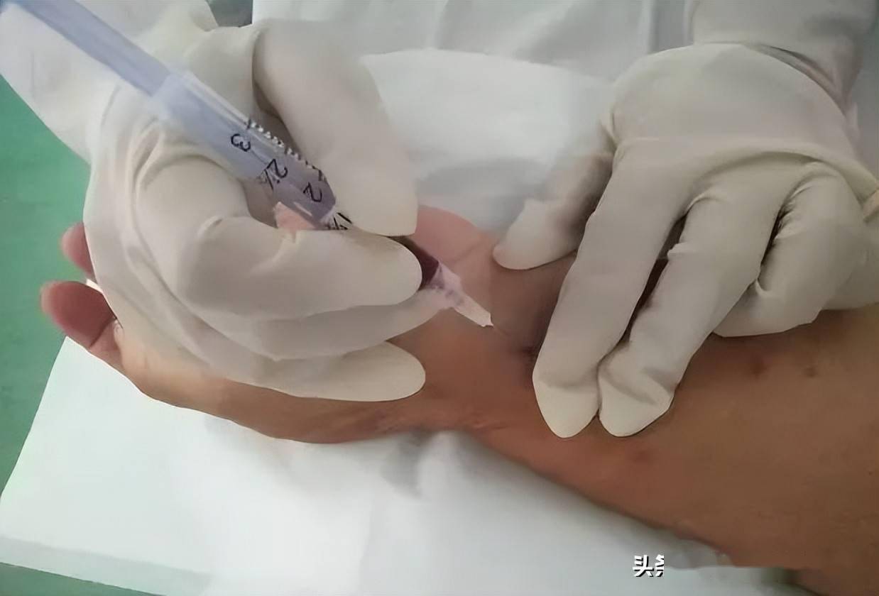 「护理小常识」桡动脉采血时,如何不错扎神经?_患者_部位_动脉血