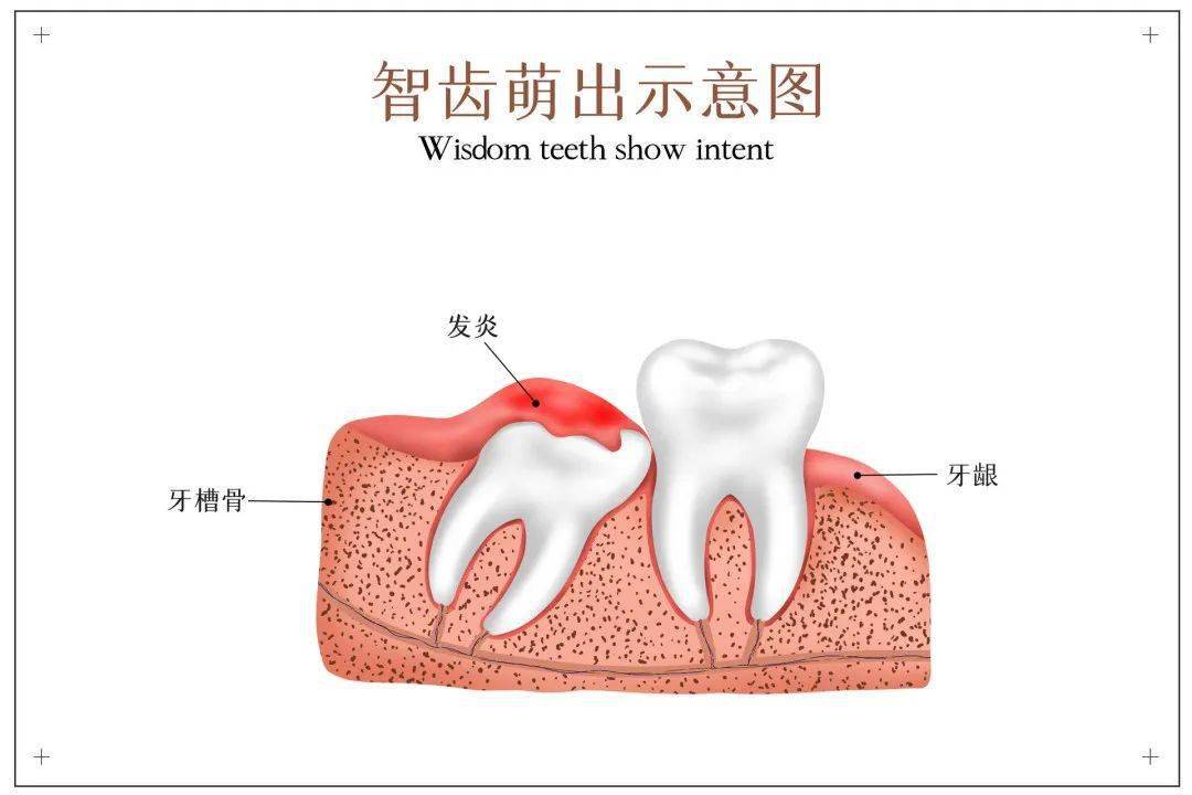 智齿长在什么位置图片