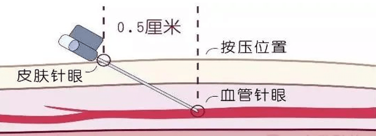 冷知识:你们一定没有注意,护士抽血的时候一般都是倾斜进针的,抽完