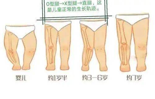 扒一扒儿童内八字的那些事儿_孩子_过程_大部分