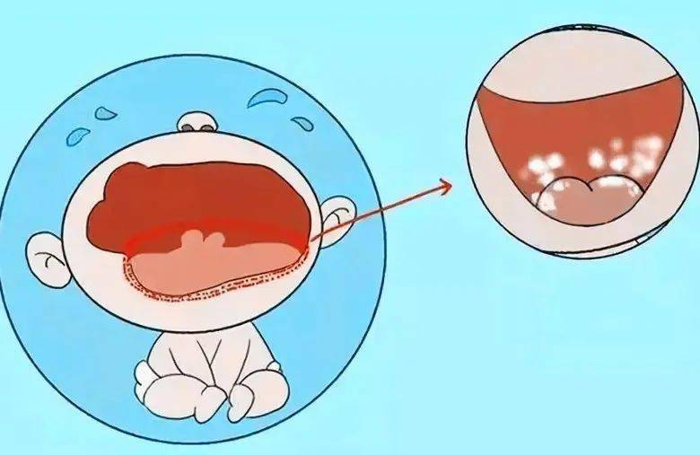 检查后竟是这种菌在捣乱_真菌_白色_左眼