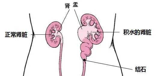 肾挛缩图片